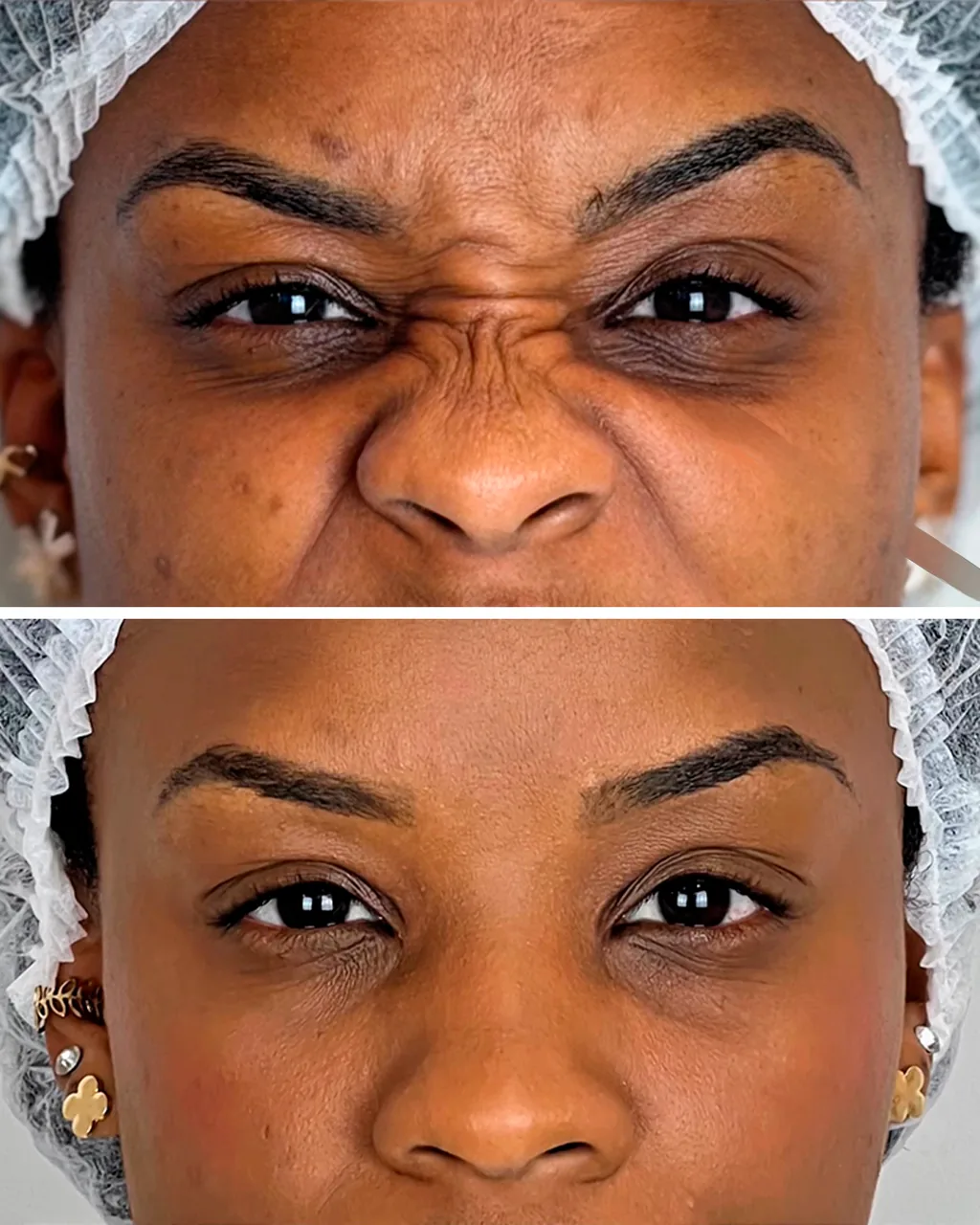 Antes e depois de aplicação de botox facial