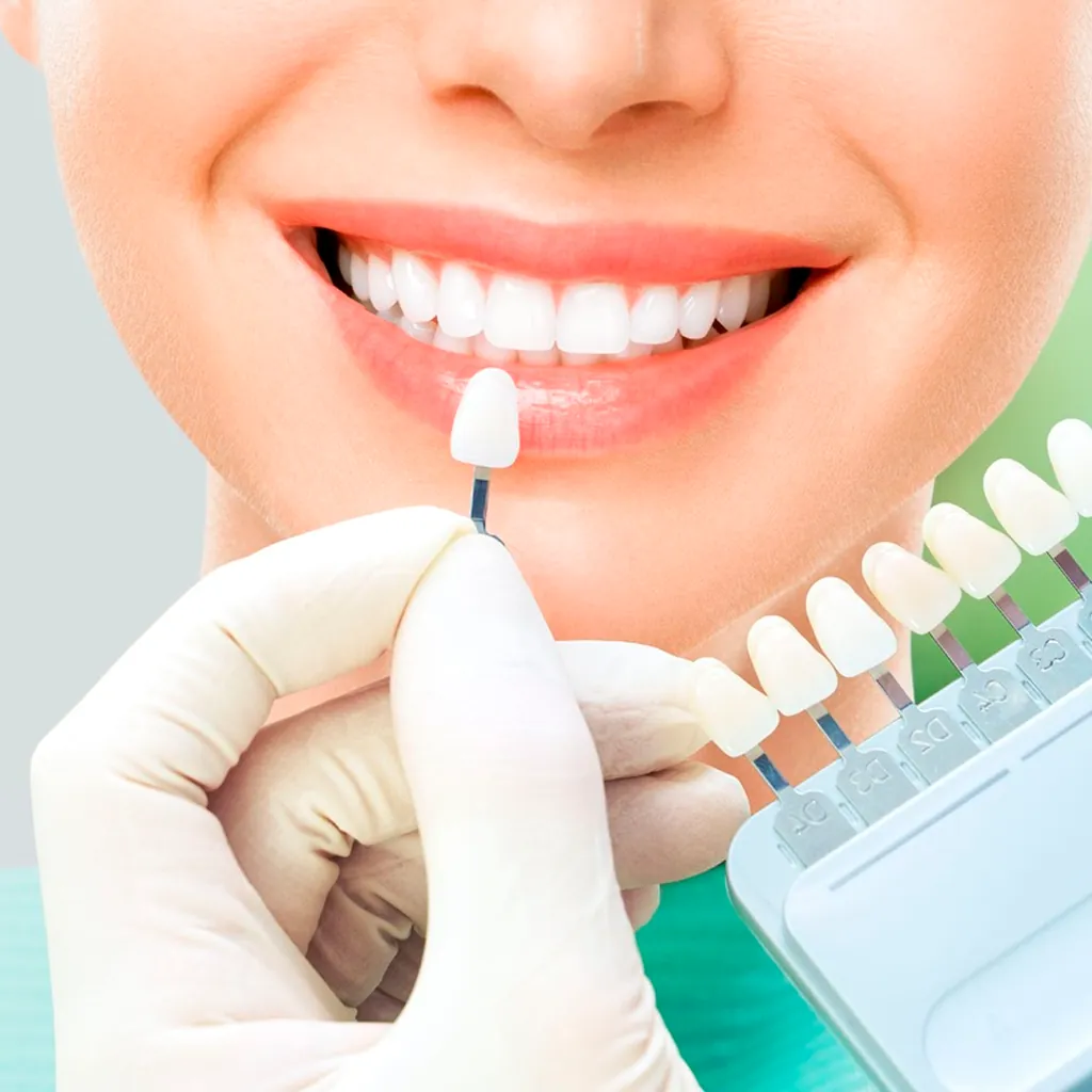 Facetas Dentárias