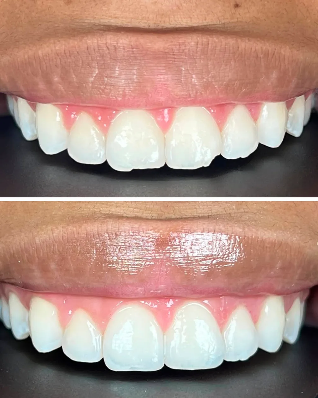 Antes e depois de facetas dentárias